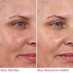 Hello Results Baby Smooth Glycolic Peel + Carin Oil - 30 ml