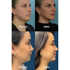 Face Sculpting & Lifting Device