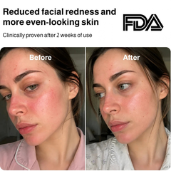 Laser Light Therapy Face Mask
