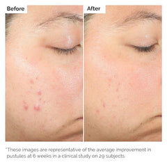 Salicylic Acid 2% Anhydrous Solution